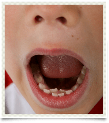 Photo of child showing lower teeth